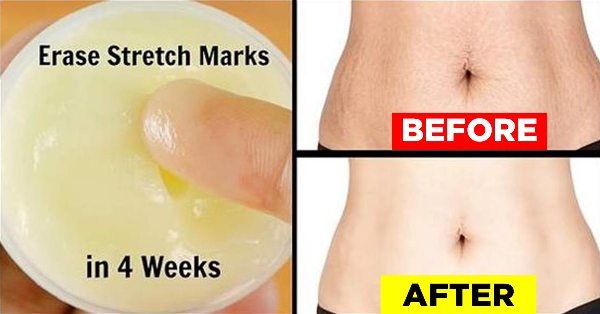 allforfashions1's tweet photo. How to Naturally Get Rid of Stretch Marks
https://t.co/YsmjmjvDn1
#stretchmarks#how to naturally get rid of stretch marks#naturally #get rid#stretch marks https://t.co/eciUNYbjE2