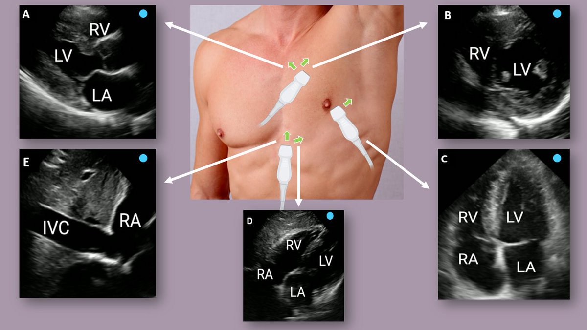 Pleasure to collaborate with big shots in the world of #Nephrology #POCUS 🤠<a href="/ArgaizR/">Eduardo R Argaiz</a> <a href="/nephrothaniel/">Nathaniel Reisinger</a>  Thanks for the opportunity!
kidney360.asnjournals.org/content/early/…