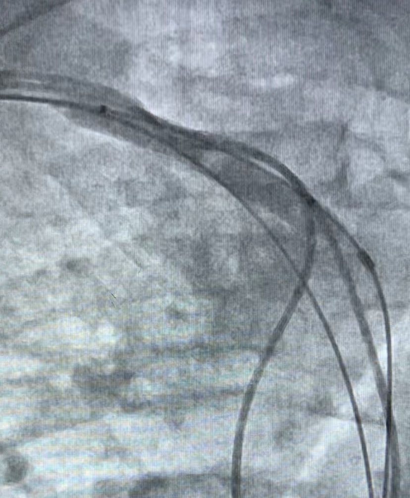 Added fibroplasty to my skill set thanks to <a href="/seth_j_worley/">Seth J Worley MD</a> and some help from my awesome <a href="/Medtronic/">Medtronic</a> team.  The Worley recommended table positioning was a game changer for right sided implants!