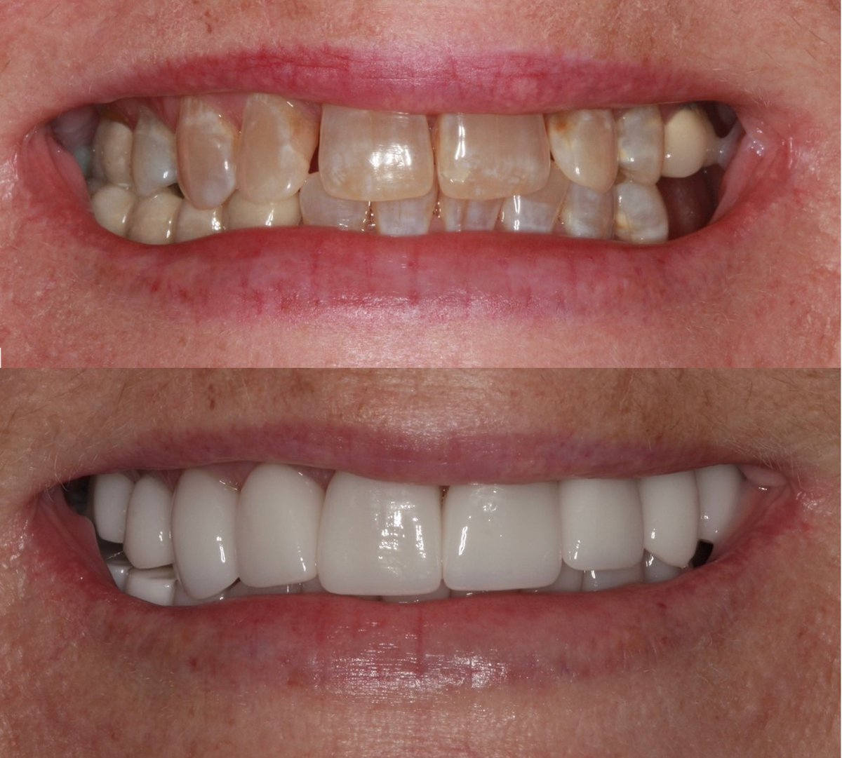 treyhmiller's tweet photo. Smile improvement using porcelain veneers to change the look of these discolored teeth. Smiling proudly now! #veneers #cosmeticdentistry #smilemakeover #amarillosmiles https://t.co/eZlQIGqbDi