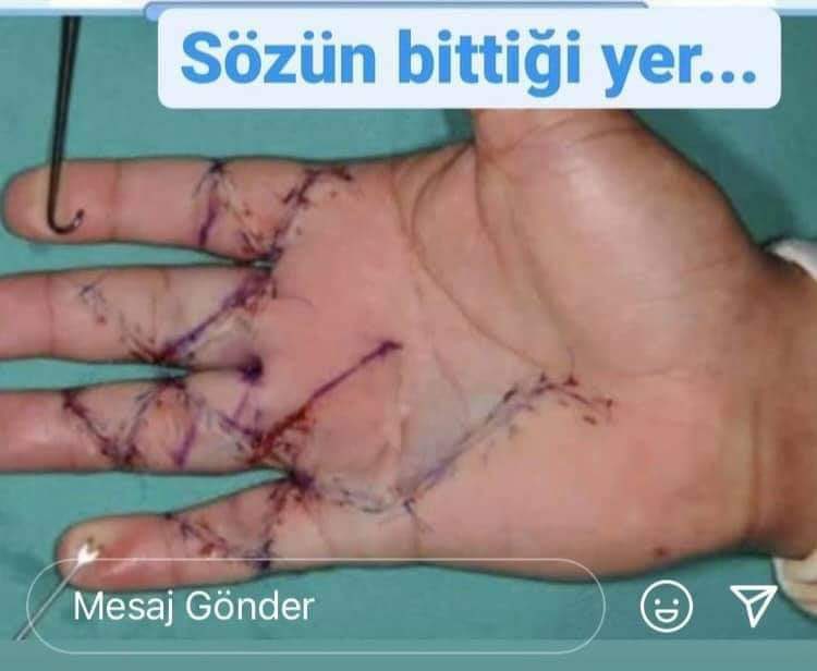 Annesinin babasının öpmeye doyamadığı, yıllarca kalem tutmuş ve umuyoruz ki yıllarca hastalarına şifa olacak bir cerrah eli görüyorsunuz. Bir kendini bilmezin saldırısı sonucu son hali bu. Umarım en kısa sürede tüm fonksiyonları normale döner. #ertaniskender