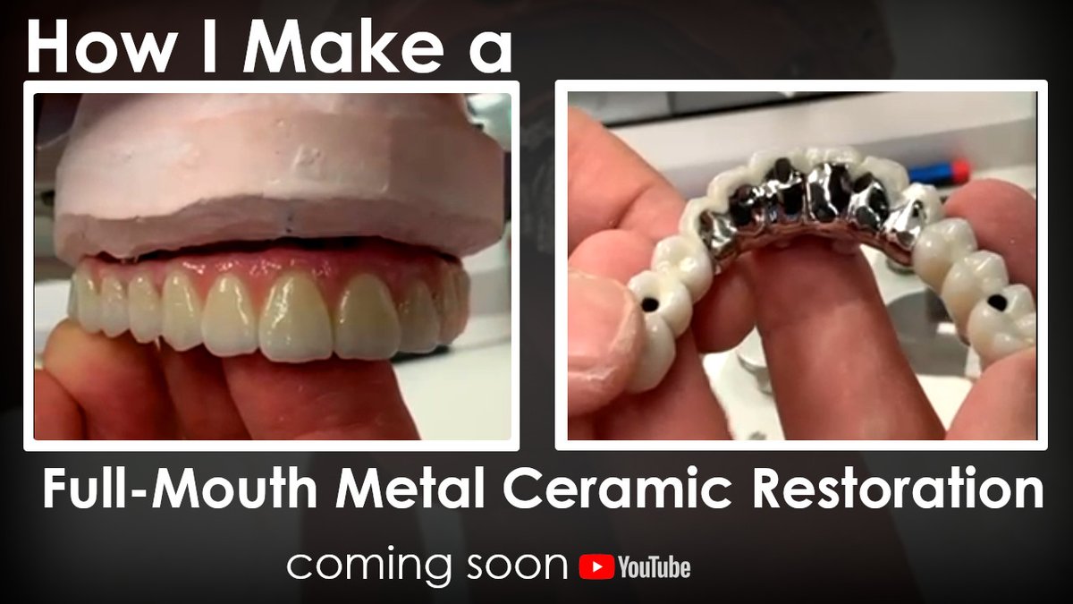 In his upcoming new video Luke Kahng will show you how he made this full-mouth metal ceramic restoration. Subscribe to his YouTube channel at youtube.com/lsk121 to make sure that you don't miss it.