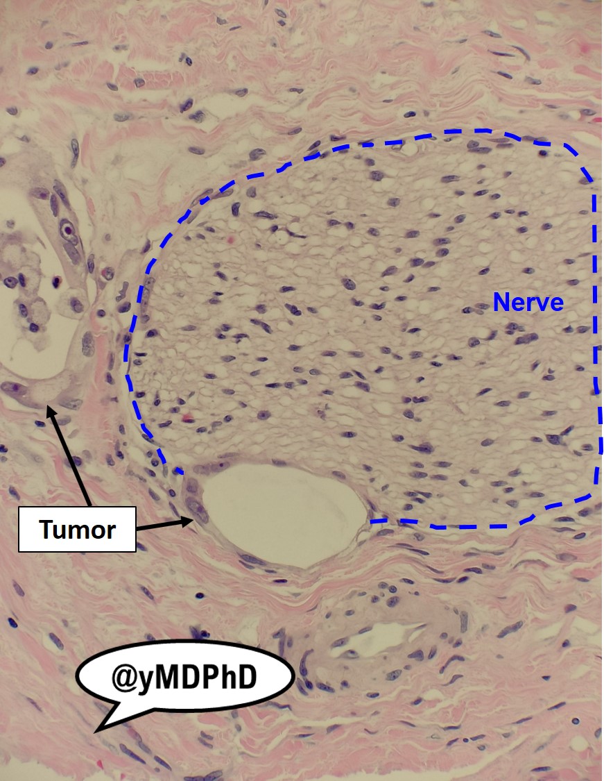 yMDPhD's tweet photo. Perineural invasion (PNI) by pancreatic adenocarcinoma:
β
An indicator of poor prognosis
β
Tumors with PNI utilize nerves as alternate routes of invasion
β
Invasion along nerves can generate pain in the patient
#yPathPearls https://t.co/YcrcQ7HUbT