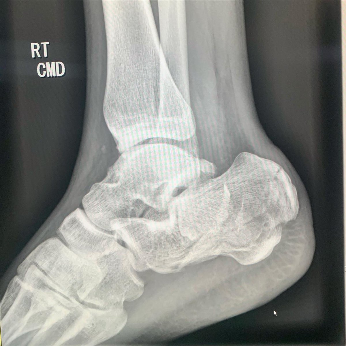 Case Report: Concurrent Sustentaculum Tali and Lateral Talar Body Fracture  in a 19 Year Old Patient