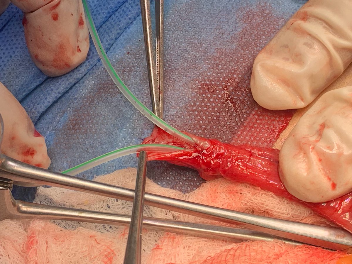 joseantonio_MD's tweet photo. Duplicated Ureter and Renal Transplantation: Use the same surgical principals for single ureters to manage duplex ureters and anastomose them either separately or combined. <EAU guidelines> #ureter #kidneytrasplant #surgery. https://t.co/lbCrm3rrxA