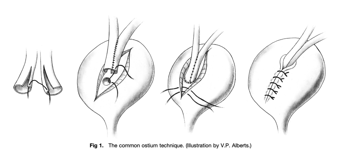 joseantonio_MD's tweet photo. Duplicated Ureter and Renal Transplantation: Use the same surgical principals for single ureters to manage duplex ureters and anastomose them either separately or combined. <EAU guidelines> #ureter #kidneytrasplant #surgery. https://t.co/lbCrm3rrxA