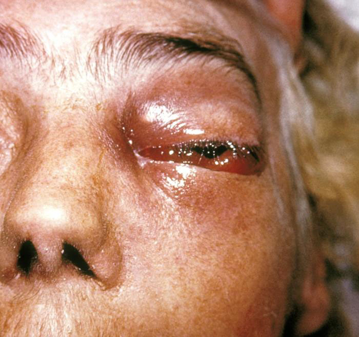Epoxico's tweet photo. Macroscopicamente la infección desarrolla necrosis de los tejidos y su tratamiento casi único es con #Anfotericina B (5/6). https://t.co/XKbrI85w9y