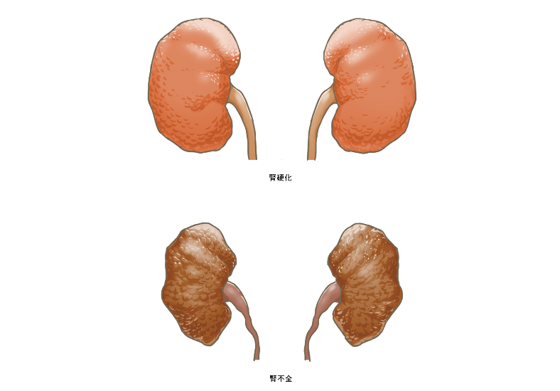 تويتر 看護roo 公式 かんごるー على تويتر 腎硬化と腎不全の状態がわかるイラストがほしいな W どうぞ フリーイラスト フリー素材 作 Kangoshi Illust 看護師 イラスト集 腎硬化と腎不全のイラスト T Co R6f4d0h6ao تويتر 看護roo 公式 かんごるー على تويتر 腎硬化と腎不全の状態がわかるイラストがほしいな W どうぞ フリーイラスト フリー素材 作 Kangoshi Illust 看護師 イラスト集 腎硬化と腎不全のイラスト T Co R6f4d0h6ao