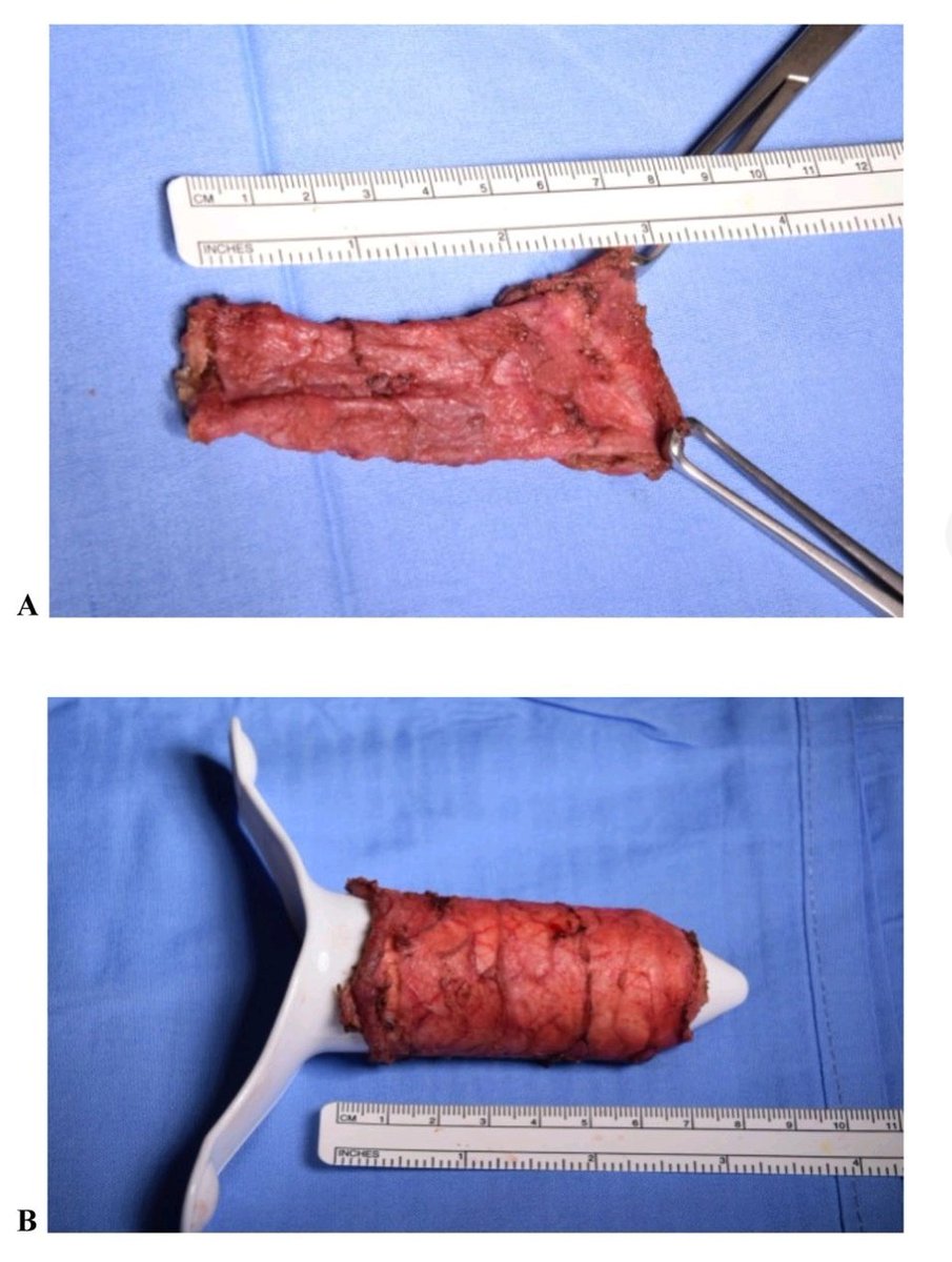 Finally in <a href="/TechColoproctol/">Techniques in Coloproctology Journal</a> the step by step instructions on how to do an "internal Delorme" the only transanal procedure for posterior compartment prolapse that does not involve staples (i.e. is safe) with video

#SoMe4Surgery #colorectalresearch #ERPP

link.springer.com/article/10.100…
