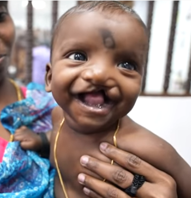 AndeiSoI's tweet photo. A hearty smile from a cutie pie #smiles #cleftsmile #facedoctor #jobsatisfaction https://t.co/ramhkiH37H