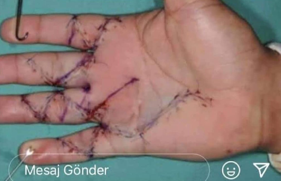 Bu el usulsüz rapor vermediği için saldırıya uğrayan bir cerrahın eli.. muhtemelen bir daha ameliyat yapamayacak… Çok acı… Artık olanlara üzülmekten yorgunuz😞…Bu şiddet iklimine son verilmeli.. Ya bir yol bulunmalı, ya da bir yol açılmalı.. 
#sağlıktasiddetyasası