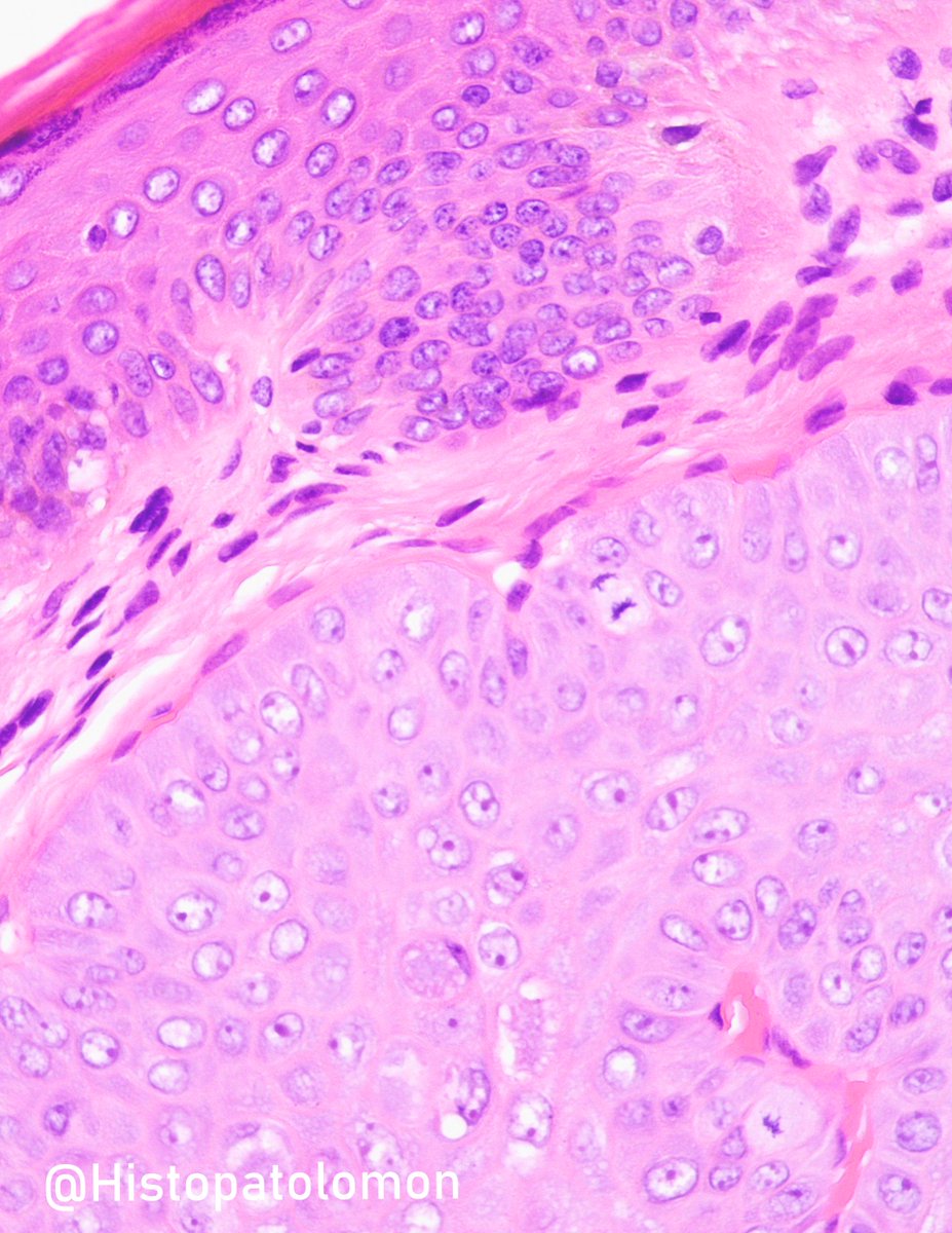 Pascual Meseguer (@histopatolomon) on Twitter photo Maybe it's difficult if you're not #dermpath. Do you need more photos? <a href="/ariella8/">Celina Stayerman MD</a> <a href="/nucleololailo/">Carlos Miguel Ruiz</a> <a href="/crisdelarco/">Cristina D. del Arco</a> <a href="/luishcruzc/">Luis Humberto Cruz C</a> <a href="/chriszioga/">Christina Zioga</a> <a href="/martiponi/">Marta Garrido Pontnou</a> <a href="/MAHoureih/">M Adib Houreih, M.D, DipRCPath محمد أديب حورية</a> <a href="/zucchiatti_/">Adriana Zucchiatti</a> <a href="/kriyer68/">Kalyani Bambal</a> <a href="/BinXu16/">Bin Xu</a> <a href="/janavarro_MD/">Toño Navarro, M.D. 🔬🎗️</a> <a href="/VHNguyenMD/">Van-Hung Nguyen MD 🇺🇦🌻</a> <a href="/Alipathy/">Alicia Núñez Abreu, MD🔬🇩🇴</a> <a href="/pbaleixo/">Pedro Aleixo</a> <a href="/PoloniaAntonio/">A. Polónia</a> <a href="/crazylymphocite/">Daniel Prieto Cuadra</a> <a href="/SansanoValero/">Irene Sansano, MD Phd</a> Maybe it's difficult if you're not #dermpath. Do you need more photos? <a href="/ariella8/">Celina Stayerman MD</a> <a href="/nucleololailo/">Carlos Miguel Ruiz</a> <a href="/crisdelarco/">Cristina D. del Arco</a> <a href="/luishcruzc/">Luis Humberto Cruz C</a> <a href="/chriszioga/">Christina Zioga</a> <a href="/martiponi/">Marta Garrido Pontnou</a> <a href="/MAHoureih/">M Adib Houreih, M.D, DipRCPath محمد أديب حورية</a> <a href="/zucchiatti_/">Adriana Zucchiatti</a> <a href="/kriyer68/">Kalyani Bambal</a> <a href="/BinXu16/">Bin Xu</a> <a href="/janavarro_MD/">Toño Navarro, M.D. 🔬🎗️</a> <a href="/VHNguyenMD/">Van-Hung Nguyen MD 🇺🇦🌻</a> <a href="/Alipathy/">Alicia Núñez Abreu, MD🔬🇩🇴</a> <a href="/pbaleixo/">Pedro Aleixo</a> <a href="/PoloniaAntonio/">A. Polónia</a> <a href="/crazylymphocite/">Daniel Prieto Cuadra</a> <a href="/SansanoValero/">Irene Sansano, MD Phd</a>