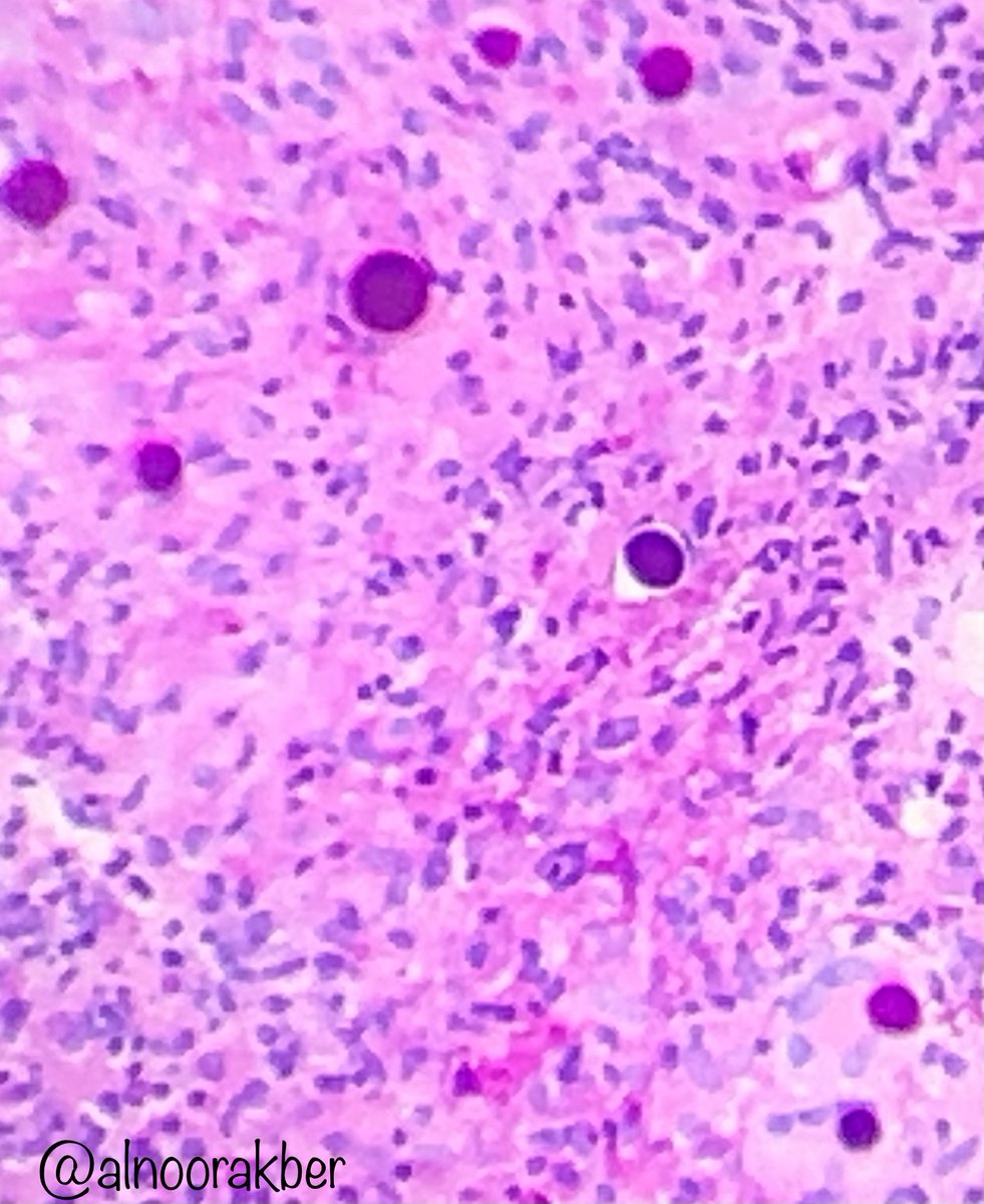 #PathTwitter #MicroMed #PathBoards #PathTweetorial

Pharyngeal abscess in a patient with travel history to southern states. 

Diagnosis: Coccidioidomycosis
Confirmed by tissue microbial culture. (1/6)
