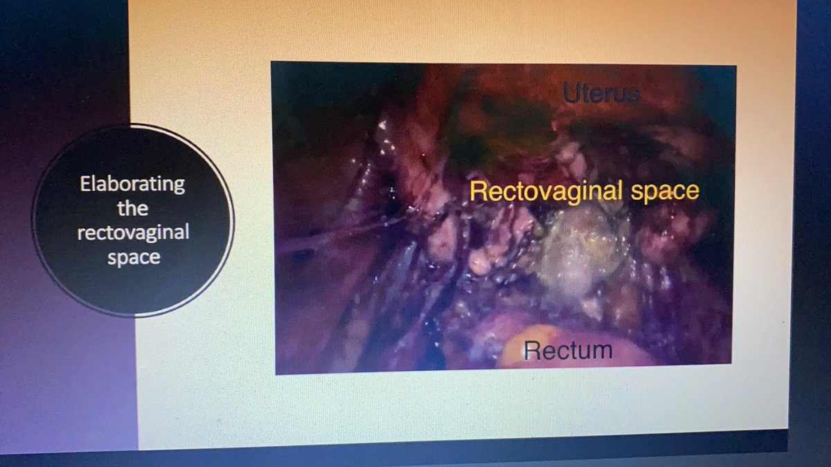 TheFemas's tweet photo. Mesmerising video presentation on #RectoVaginalEndometriosis #FatBelongsToBowel #RectalShaving as we #dissect approach the #RectoVaginalSpace  at #Femas3PointZero @TheFemas #OneDay #InternationalWorkshop  in assoc. with @gchysteroscopy @harofe64 #HospitalsApollo Convener @Niru22 https://t.co/YRmtunAHvO