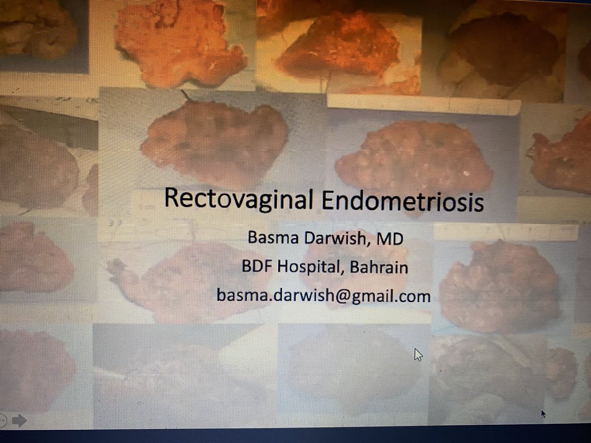 TheFemas's tweet photo. Mesmerising video presentation on #RectoVaginalEndometriosis #FatBelongsToBowel #RectalShaving as we #dissect approach the #RectoVaginalSpace  at #Femas3PointZero @TheFemas #OneDay #InternationalWorkshop  in assoc. with @gchysteroscopy @harofe64 #HospitalsApollo Convener @Niru22 https://t.co/YRmtunAHvO