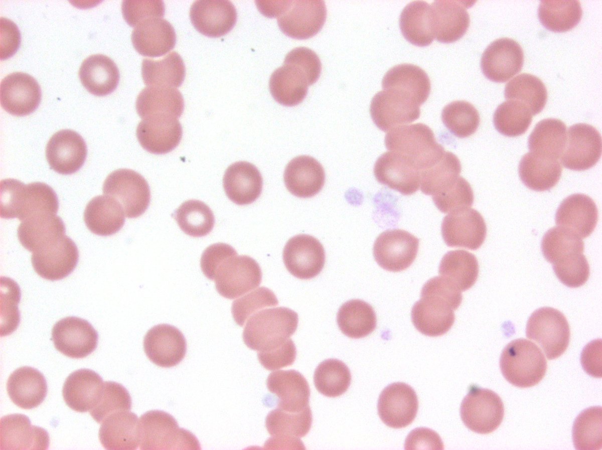 Just a nice pic of rouleaux associated with plasma cell myeloma