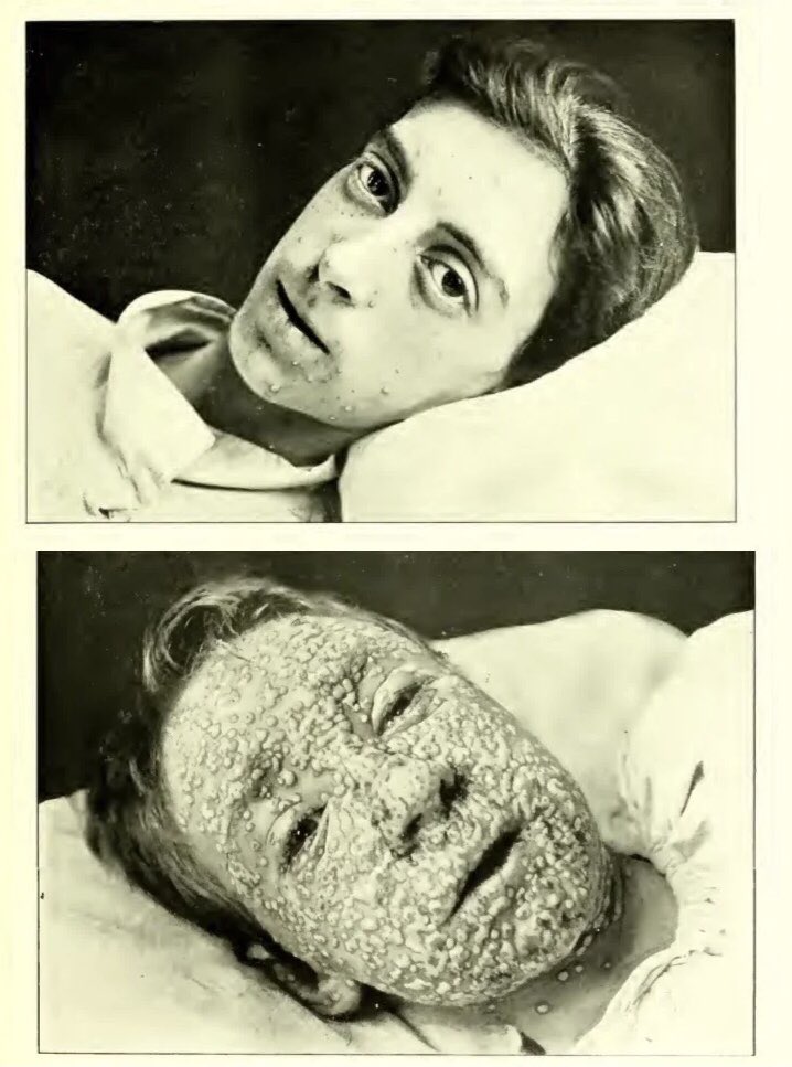 De las dos hermanas de la foto, en ese momento una tenía 21 años, la otra 15.
Igual no aciertas quién es la de 21 y quién la de 15…
Pero seguro aciertas la que sí se vacunó contra la viruela y la que no #VaccinesWork