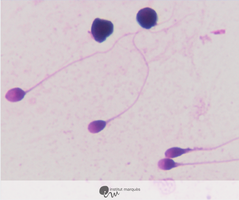imarques_EN's tweet photo. FERTILE®, a new technique for sperm selection in the lab, to select the best spermatozoa in cases of raised #DNAFragmentation, a pathology that can cause #infertility, repeated failures in #ART or lead to #recurrentmiscarriages. #assistedreproduction https://t.co/ycl1PX0BDo https://t.co/rXzW6KMrmY