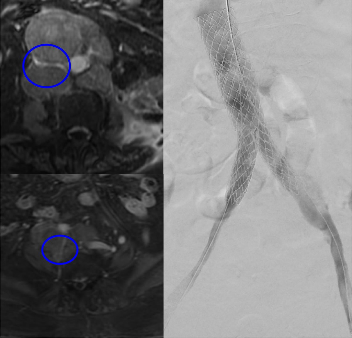 Rahul Sheth (@rahulshethmd) on Twitter photo Malignant compression of iliocaval system by bulky nodes causing DVT and severe leg swelling. Treated with <a href="/InariMedical/">Inari Medical</a> ClotTriever and balloon mounted stents for their size and strength. @BC_Odisio <a href="/HCIRad/">Houston Combined IR Residency</a> <a href="/CHICKVIR/">Jeffrey F. B. Chick, MD, MPH</a> <a href="/SIRRFS/">SIR RFS</a> <a href="/SIRspecialists/">Society of Interventional Radiology</a> Malignant compression of iliocaval system by bulky nodes causing DVT and severe leg swelling. Treated with <a href="/InariMedical/">Inari Medical</a> ClotTriever and balloon mounted stents for their size and strength. @BC_Odisio <a href="/HCIRad/">Houston Combined IR Residency</a> <a href="/CHICKVIR/">Jeffrey F. B. Chick, MD, MPH</a> <a href="/SIRRFS/">SIR RFS</a> <a href="/SIRspecialists/">Society of Interventional Radiology</a>