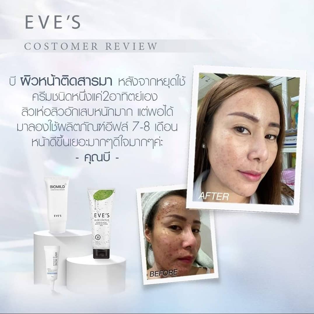 Supravee32's tweet photo. เรื่องสิวๆ เราจัดการได้ สารพัดสิวที่ทำให้ใครหลายๆคนกลุ้มใจ

3 STEP #เซตรักษาสิวขั้นเทพ

❌ไม่ต้องพึ่งหมอ❌ 

❌ไม่ต้องจ่ายแพง❌

1.#อโลอีฟส์

2.#ไบโอมายอีฟส์

3.#ครีมแต้มสิวอีฟส์

#1090บาทจัดส่งฟรี https://t.co/lDBkVLTjcZ