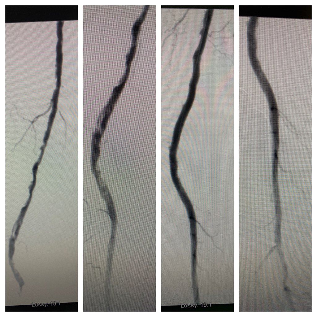 72 yo M offered amputation after failed attempt at crossing CTO at another facility.  Femoral endarterectomy with antegrade and pedal access for through and through wire access, angioplasty/stent.  Now post op one month, wounds healing, abi from 0.2 to now 0.88.