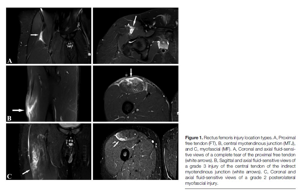Rectus femoris-the neglected step-child of thigh muscle injury in football finally getting some love with the largest MRI documented series to date
Free tendon injuries only associated with kicking (not sprints)
Rehab &amp; injury prevention implications 
dx.doi.org/10.1097/JSM.00…