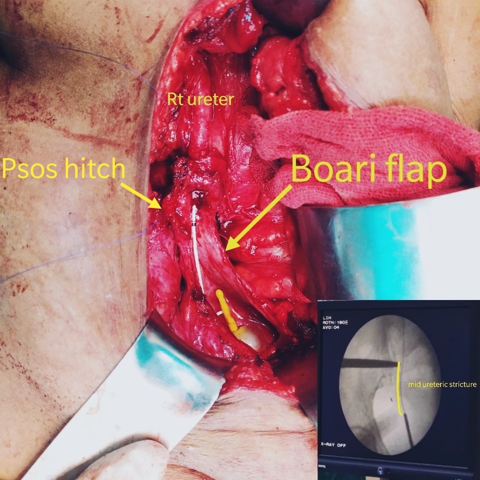 psos hitch &amp; Boari flap ureteric reimplantation for Right mid ureteric stricture #urology #urosurgery 
<a href="/jj_urology/">JJ School of Reconstructive Urology</a> <a href="/Dr_MayankAg/">Mayank Agrawal 🇮🇳</a>
