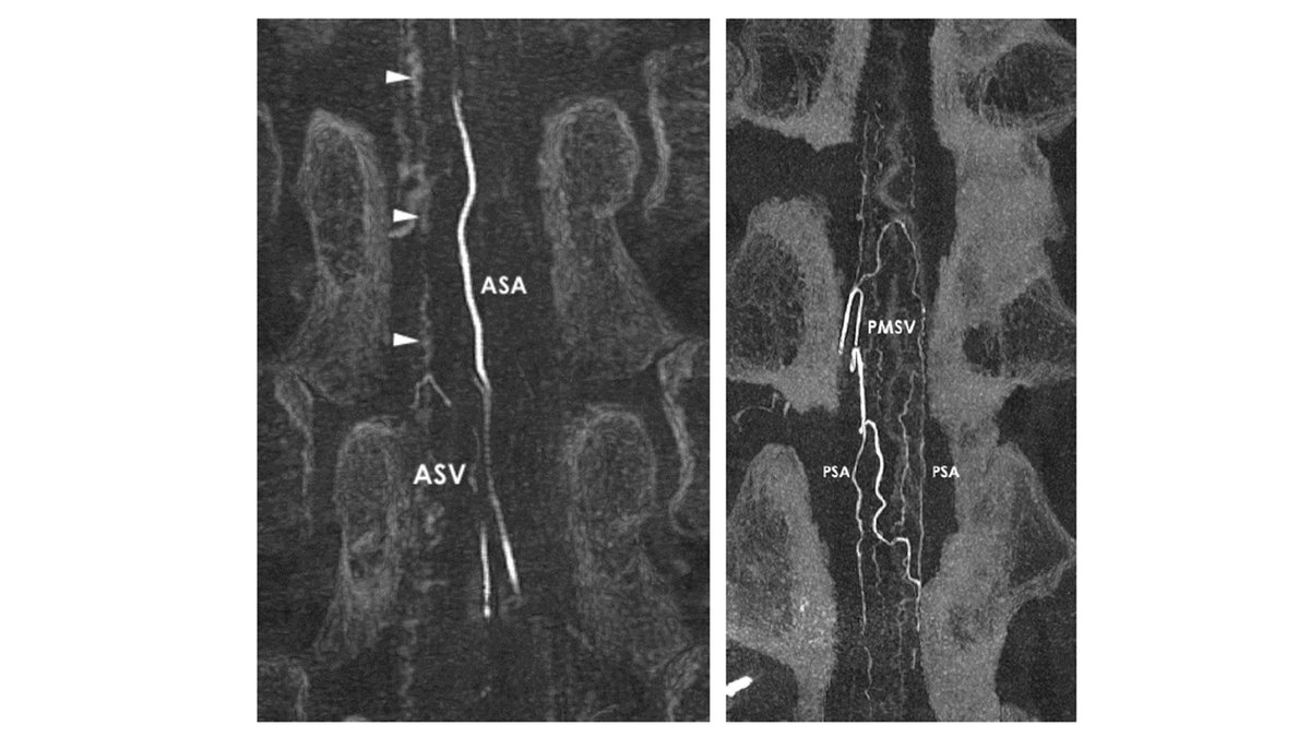 nicheneuroangio's tweet photo. NNAC19-Lecture1: Vascular anatomy of the spinal cord (in Japanese) by Dr. Tomoya Ishiguro, Osaka City General Hospital. #ASA #PSA # VasaCorona #ASV #PSV #radicular #radiculopial #radiculomedullary https://t.co/hxvQHPQq4H https://t.co/Zr9ptRoZDP