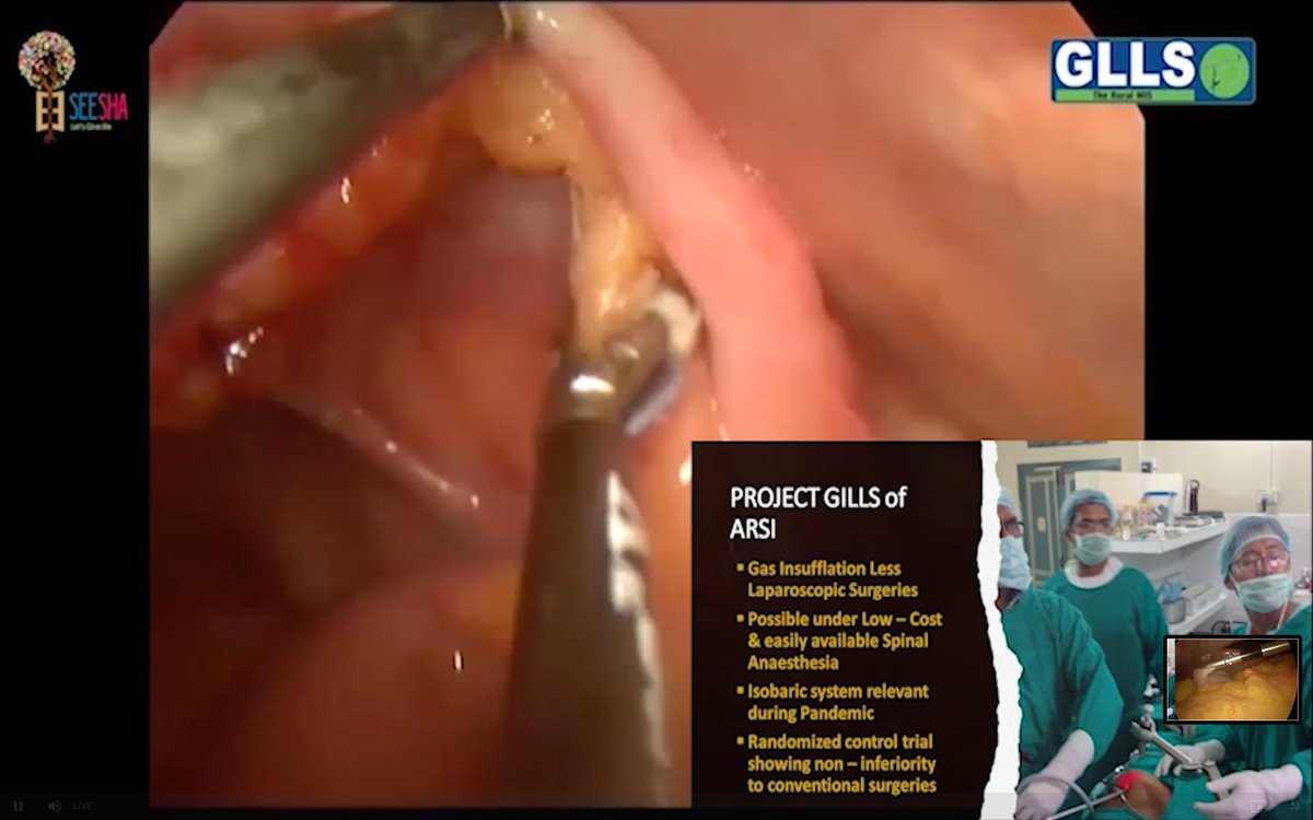 cgstaglobalsurg's tweet photo. The second @MUHC_GSC session has started on the innovation in laparoscopic surgery in India. Looking forward to a brilliant discussion on barriers and opportunities. #RuralSurgery #GlobalSurgery https://t.co/mBAj3E1ZLv