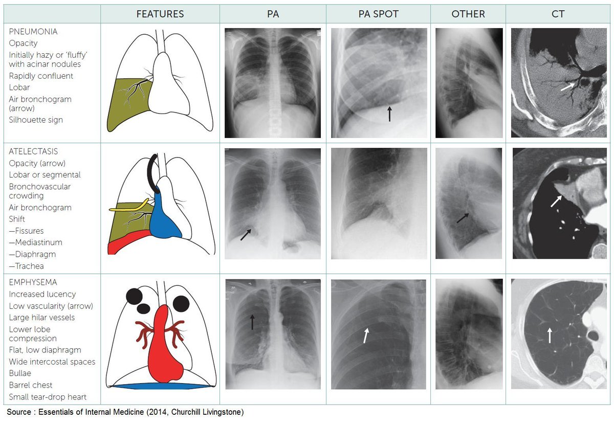 PatologCritica's tweet image. #PatologíasPulmonares: Características e Imágenes Radiológicas!!!
Recordamos estos completos Resúmenes Visuales!!!