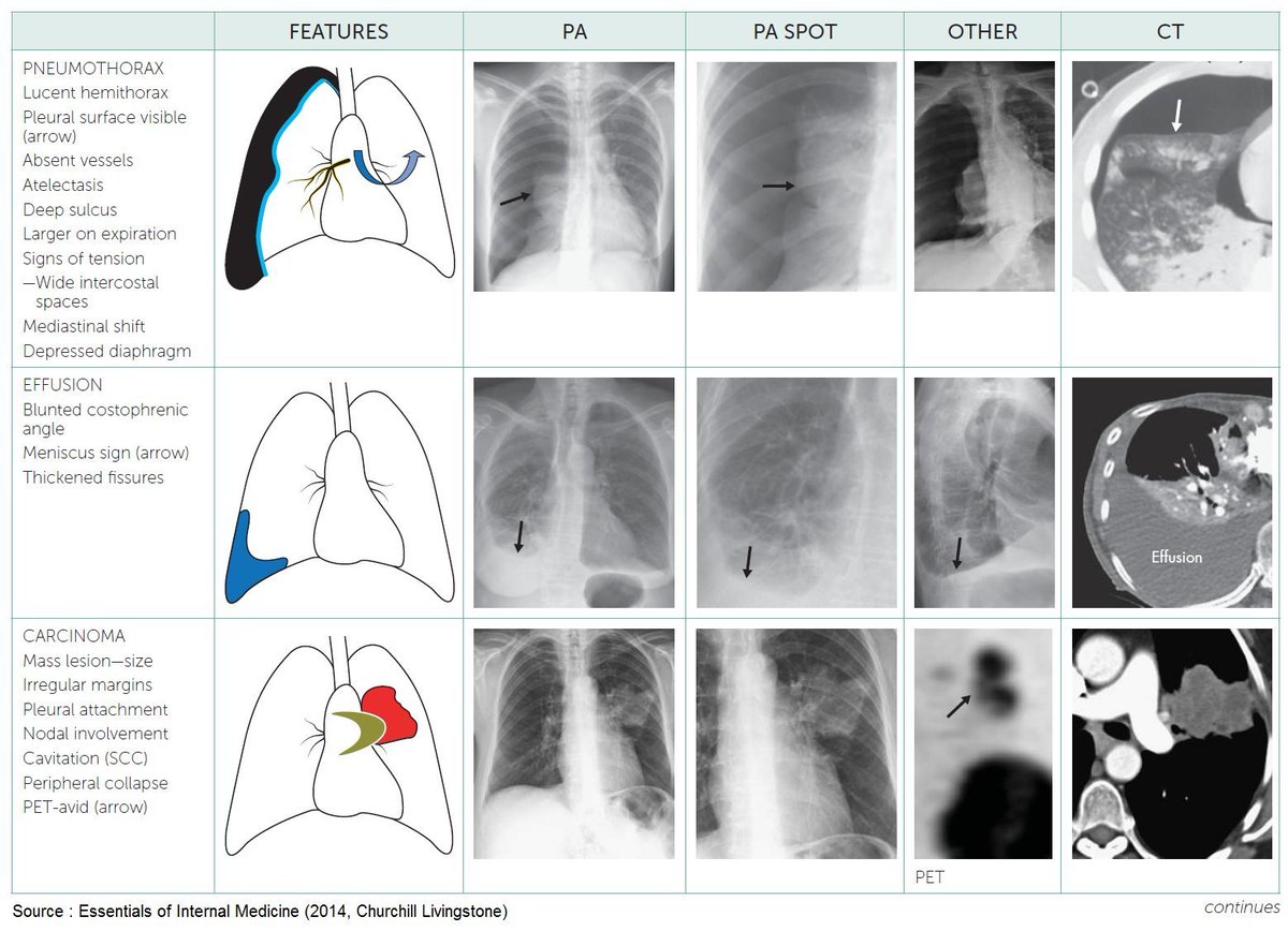 PatologCritica's tweet image. #PatologíasPulmonares: Características e Imágenes Radiológicas!!!
Recordamos estos completos Resúmenes Visuales!!!