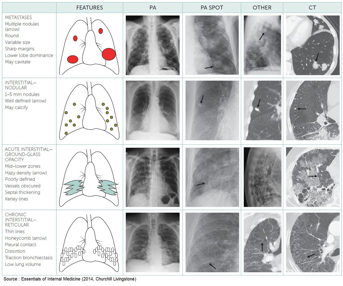 PatologCritica's tweet image. #PatologíasPulmonares: Características e Imágenes Radiológicas!!!
Recordamos estos completos Resúmenes Visuales!!!