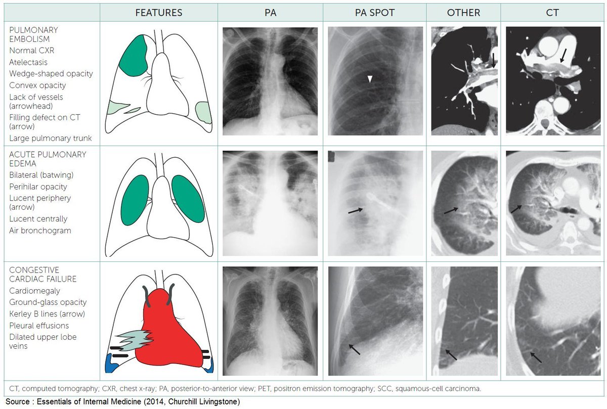 PatologCritica's tweet image. #PatologíasPulmonares: Características e Imágenes Radiológicas!!!
Recordamos estos completos Resúmenes Visuales!!!
