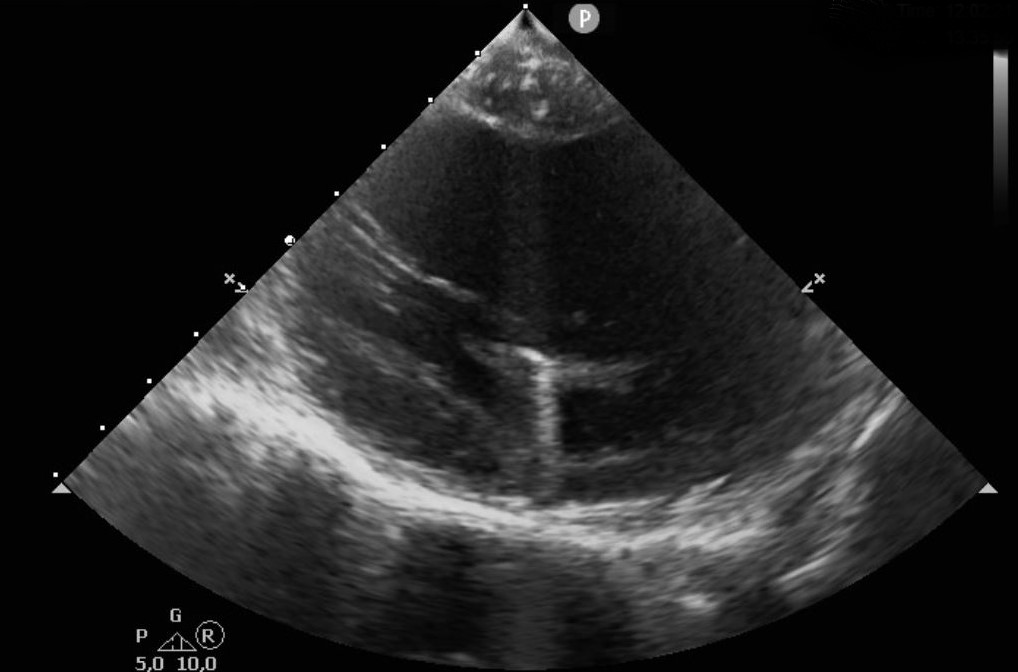 thegellergroup's tweet image. #ICEeyes and #HDmapping for ablation of papillary muscle VAs. Anatomical and electrophysiological information for a successful treatment. 
Case 1 (intial experience with NavX PM-mapping)