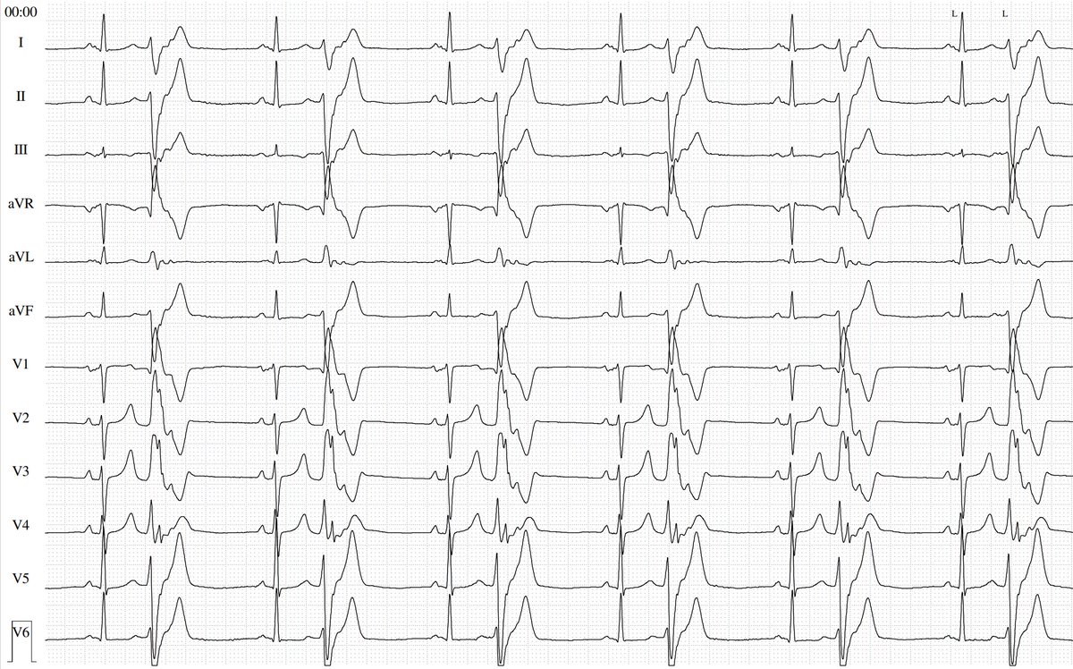 thegellergroup's tweet image. #ICEeyes and #HDmapping for ablation of papillary muscle VAs. Anatomical and electrophysiological information for a successful treatment. 
Case 1 (intial experience with NavX PM-mapping)