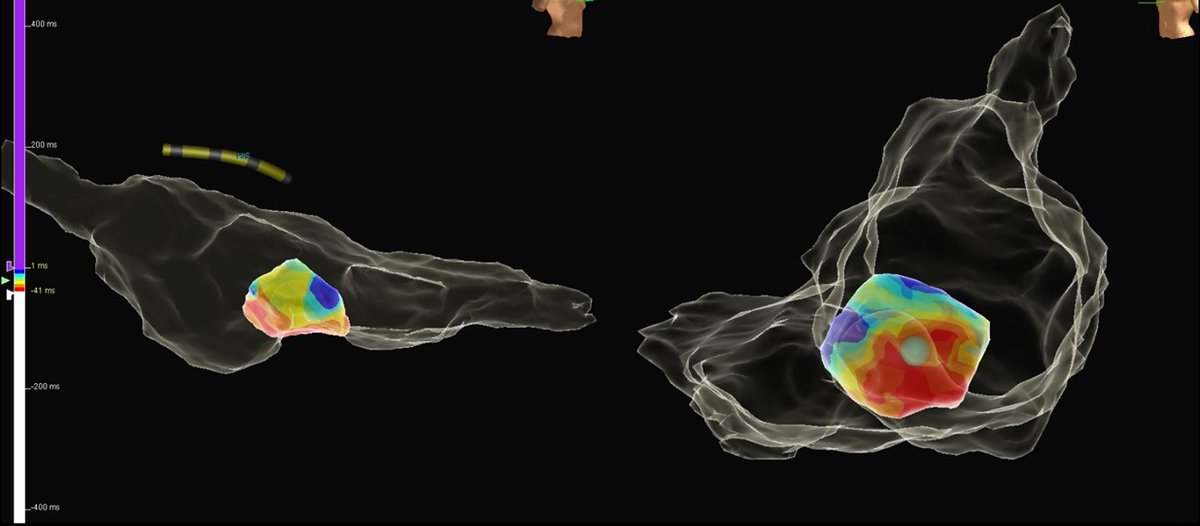 thegellergroup's tweet image. #ICEeyes and #HDmapping for ablation of papillary muscle VAs. Anatomical and electrophysiological information for a successful treatment. 
Case 1 (intial experience with NavX PM-mapping)