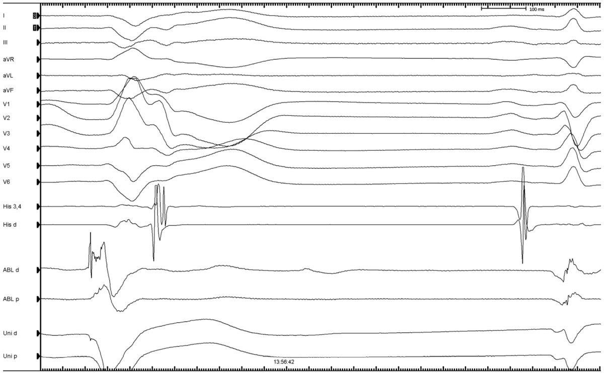 thegellergroup's tweet image. #ICEeyes and #HDmapping for ablation of papillary muscle VAs. Anatomical and electrophysiological information for a successful treatment. 
Case 1 (intial experience with NavX PM-mapping)