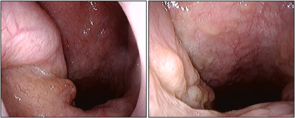 Remember to include amyloidosis in your differential for nasopharyngeal masses! Check out this case of a patient presenting with hearing loss, right exudative otitis media, and a nasopharyngeal mass. Learn more here: sciencedirect.com/science/articl… <a href="/AmJOtol/">American Journal of Otolaryngology</a> <a href="/headmirror_com/">Headmirror.com</a> <a href="/theOtoNotes/">OtoNotes.com</a>