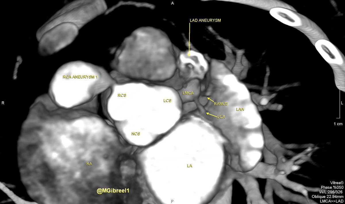 MGibreel1's tweet photo. 1/2
Case of the week ,,, From my archive 
Such coronary aneurysms in a 14 month-old 
Thrombosed &amp; calcified proximal LAD aneurysm 
Partially thrombosed RCA aneurysms
Kawasaki disease ,,,, https://t.co/m3MZ3m6F7E