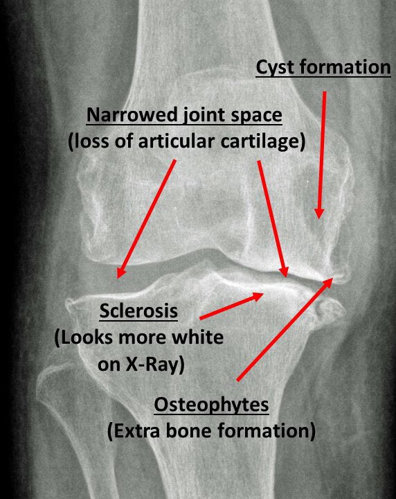 Subchondral Sclerosis subchondral-sclerosis