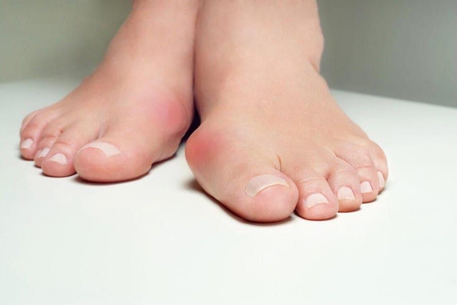Vigor_PT's tweet photo. Bunion Physical Therapy to Relieve and Restore
https://t.co/fJkRAkQ9Na #pt #bunion https://t.co/wpeolTulhV