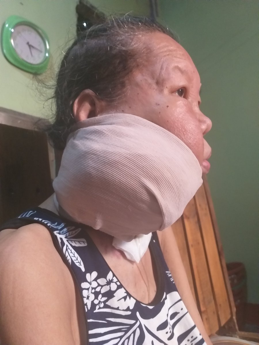 Aprilmapalad's tweet photo. Hi good day ako po si april may mapalad humihingi po ako ng tulong para sa nanay ko may sakit na PAPILLARY THYROID CANCIROMA sana po matulungan nyo ako @143redangel @KM_Jessica_Soho @gmawowowin @erwintulforeal https://t.co/231jgU35Is