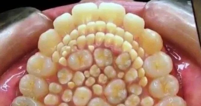 PasionAnatomia's tweet photo. Los #odontomas son tumores benignos originados a partir de una alteración de las células odontogénicas que pueden dar lugar a múltiples estructuras semejantes a dientes pequeños. El récord lo tiene Ashik Gavai, un joven indio al que en el año 2014 le extrajeron 232 dientes. https://t.co/OkwajXOZZo