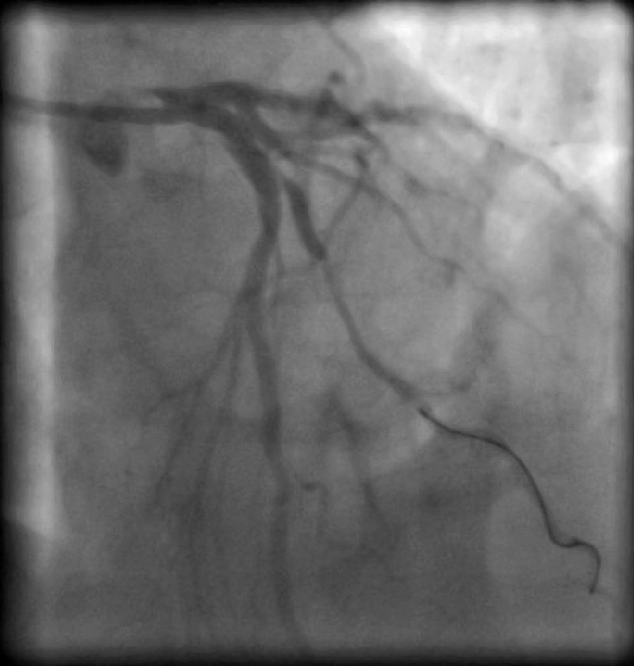 HAEQuebec's tweet image. Congrats to Dr. Ivo Bernat for using #OptoWire III at University Hospital Pilsen in Czech Republic

Patient with hypertension, dyslipidemia and exsmoker is now asymptomatic after stent implantation to diagonal branch and compression by TR Band on left radial artery
@AllInCoroPhy