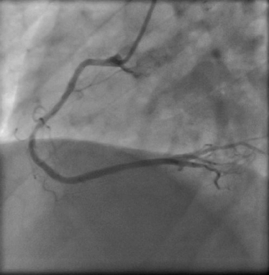 HAEQuebec's tweet image. Congrats to Dr. Ivo Bernat for using #OptoWire III at University Hospital Pilsen in Czech Republic

Patient with hypertension, dyslipidemia and exsmoker is now asymptomatic after stent implantation to diagonal branch and compression by TR Band on left radial artery
@AllInCoroPhy