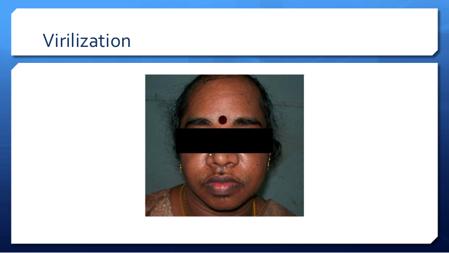 DrVinodEndo's tweet photo. #Virilization consists of #hirsutism, acne, and irregular menses along with signs of masculinization: deepening of the voice, increased muscle mass, temporal balding, #clitoromegaly, and increased libido.@monty_doc @Endocrinologia4 @SwatiGem @nishanigil @fdossa @mondal_sunetra https://t.co/zkPDPkxqlb