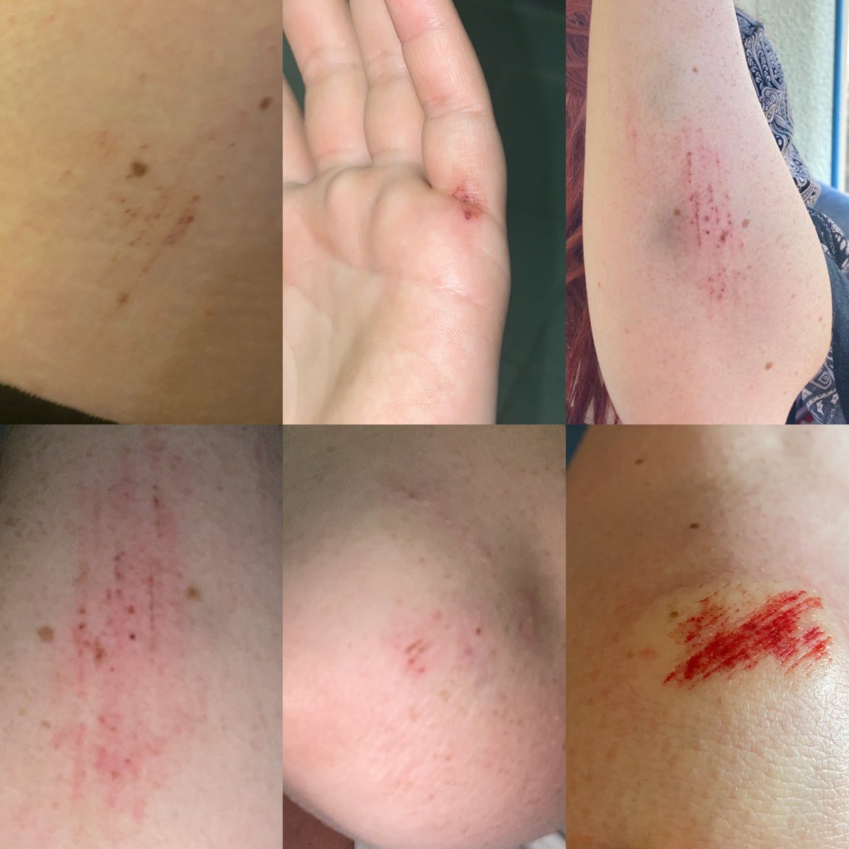 Aftermath of the quad bike crash that I still can’t remember. I was very lucky. 🙏🏻❤️ not going to lie, I feel a bit badass #injury #crash #becareful #blood