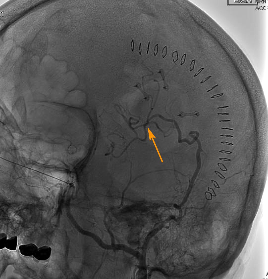DrWalterJean's tweet photo. As a coda to the #Stroke Awareness Month of May, recall that augmentation of cerebral blood flow with #bypass can sometimes be part of the solution to hypoperfusion. #ecic #stamca #moyamoya #neurosurgery https://t.co/sz1q8FkUXi