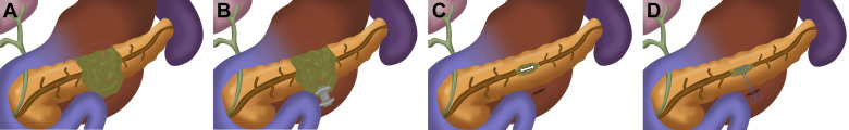 In treatment of pancreatic fluid collections with LAMS in patients with disconnected pancreatic duct syndrome, it is important to replace the LAMS with indwelling plastic stents to minimize pancreatic fluid collection recurrence and reduce morbidity ow.ly/VDET50EW9QN