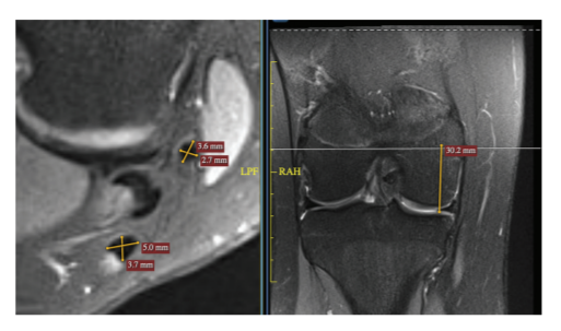 Pediatric #ACLR with a small graft diameter has an increased risk of failure. Averaging multiple #MRI measurements during pre-op planning to predict hamstring graft diameter can help identify and avoid suboptimal graft. ow.ly/vrId50EXeEr